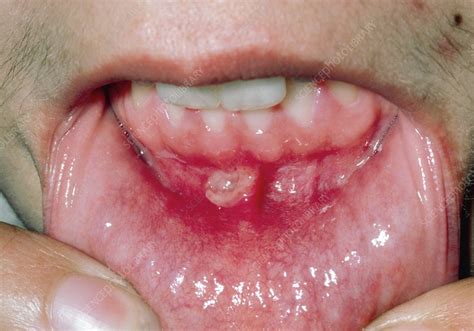 Aphtha Mouth Ulcer On Base Of Gums Stock Image M2800061
