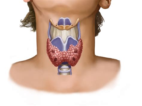 Overdiagnosis Could Be Behind Jump In Thyroid Cancer Cases Ncpr News