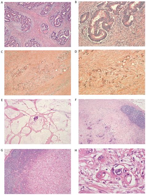 Stages Of Primary Tumor Regression And Regional Lymph Node Metastasis