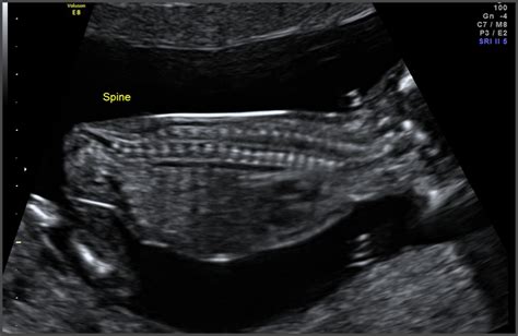 15 Weeks Pregnant Ultrasound