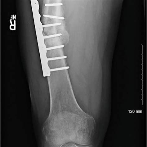 Right Femur Anteroposterior Radiograph Depicting Catastrophic Hardware