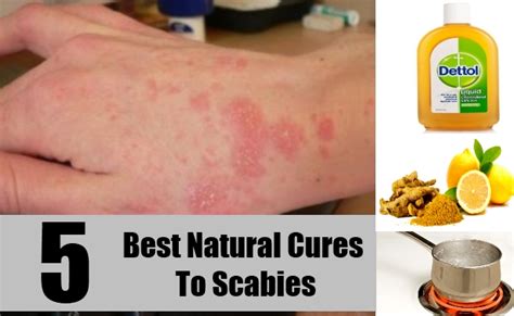 How To Get Rid Of Scabies Naturally