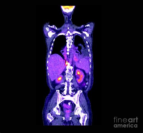 Pet Ct Scan Of Lung Cancer Photograph By Living Art Enterprises Llc