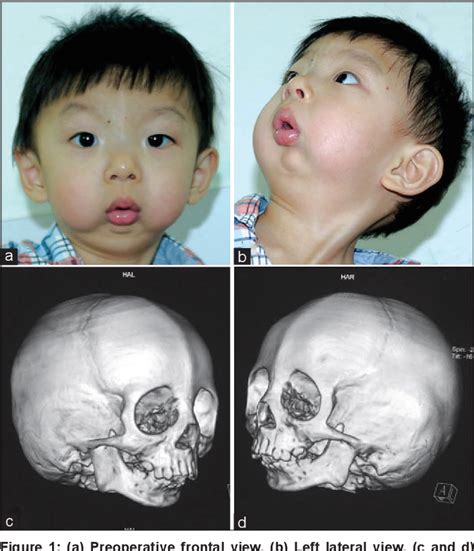 Figure 1 From Bilateral Pediatric Mandibular Distraction For