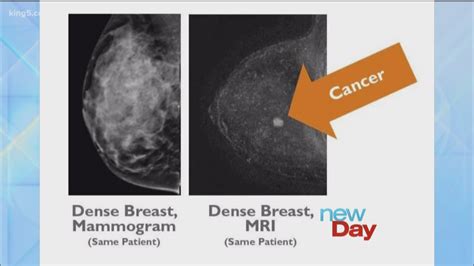 What Is Breast Density And Why Does It Matter