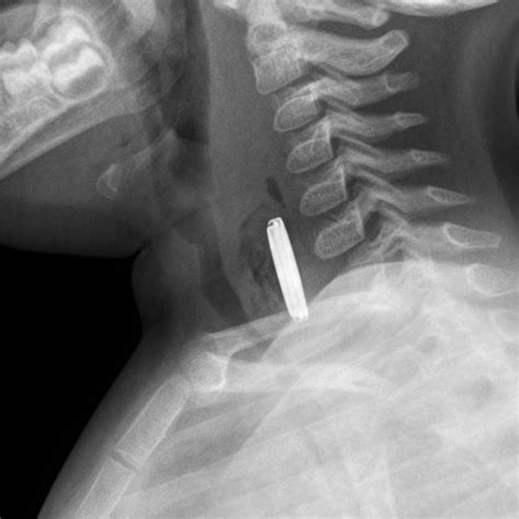 Utah Pediatric Radiology Case Of The Week 21 Month Old With Stridor