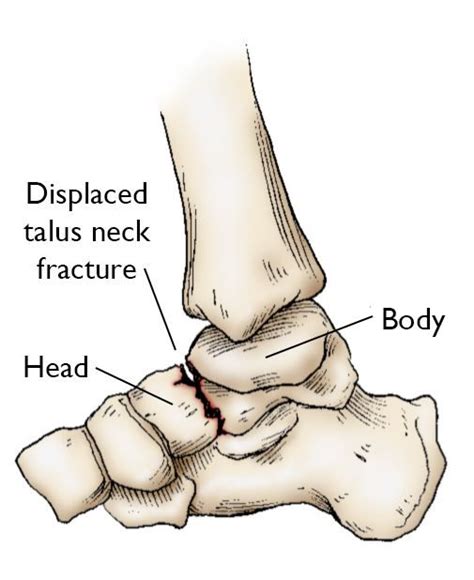 Talus Bone Neck Anatomy Unlabeled