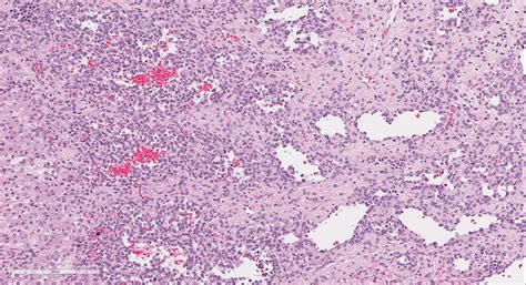 Pathology Outlines Infantile Hemangioendothelioma Hemangioma