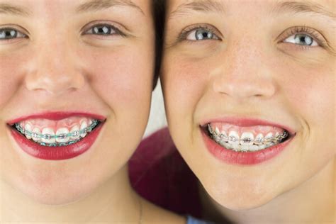 The Top Health Benefits Of Braces Valderrama Orthodontics