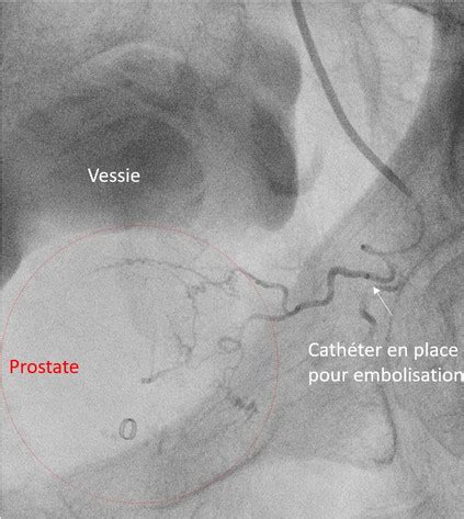 Traitement De La Prostate Par Embolisation Embolyon