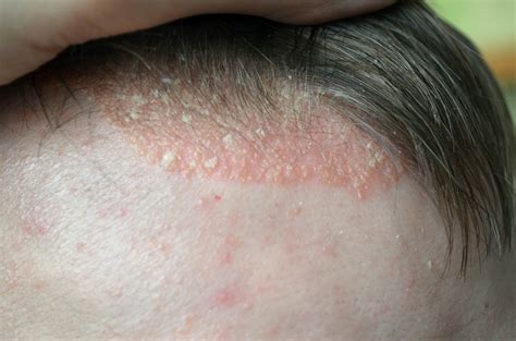 Remedies For Psoriasis Of The Scalp Health N