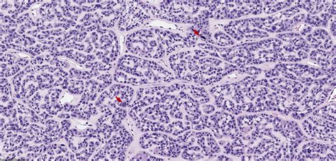 Pathology Outlines Hpv Related Multiphenotypic Sinonasal Carcinoma