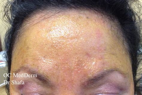 Bumps On Face And Neck Gallery Oc Medderm Irvine Dermatology