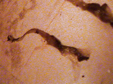 parasite worm from stool on curezone image gallery