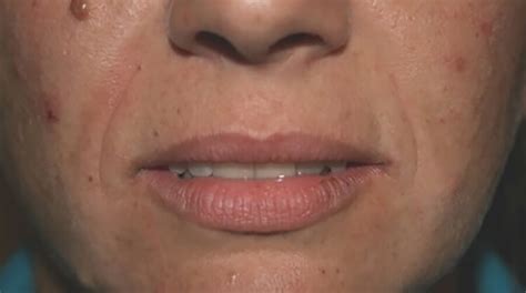 Dermal Fillers In Leeds City Centre Face Perfect Clinic