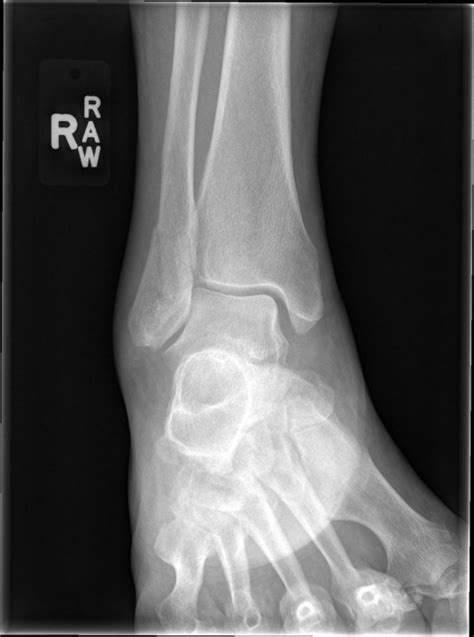 Distal Fibula Ankle Fracture