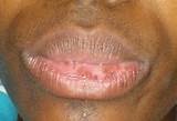 Pictures of Lip Lightening Cream For Dark Lips White Doctors
