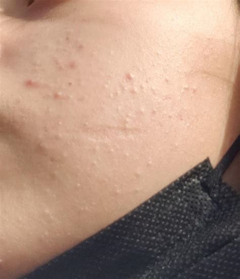 Skin Concerns What Are All These Bumps On My Face Are They Fungal