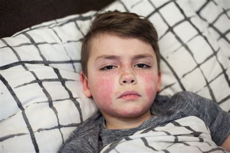 Scarlet Fever What Is Causes Symptoms And Treatment