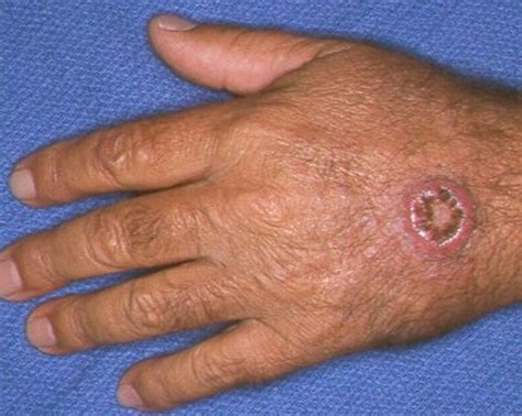 Keratoacanthoma Pictures Symptoms Treatment Causes Diagnosis