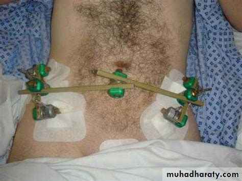 Pelvic Fractures pptx - D. Haider - Muhadharaty