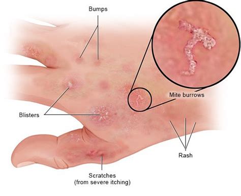 Scabies Informedhealth Org