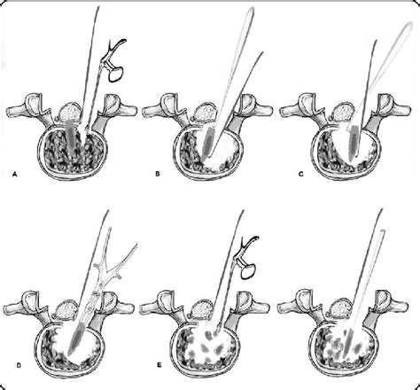 Cage Retropulsion Removal A The Fibrous Tissue Inside The Affected