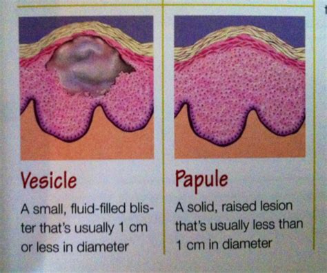 Types Of Lesions Vesicle Papule Nclex Nclex Rn Nursing Exam