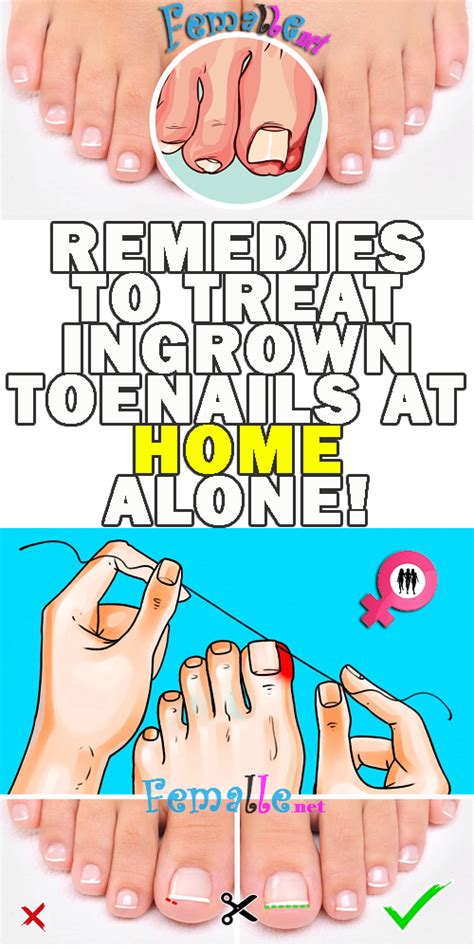 Here They Are 5 Remedies To Treat Ingrown Toenails At Home Alone