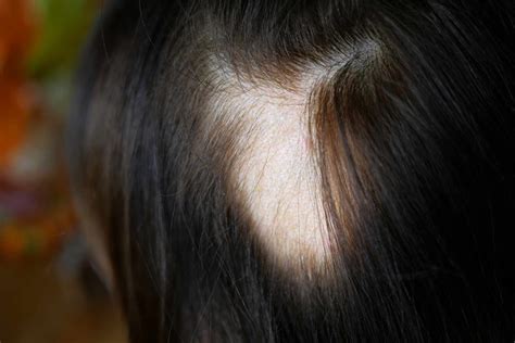 Top Image What Causes Hair Loss In Women Thptnganamst Edu Vn