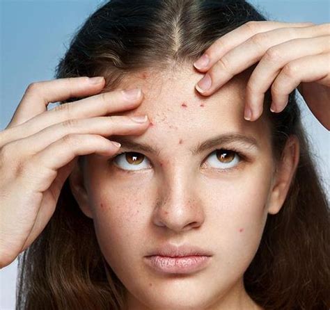 10 Home Remedies For Pimples