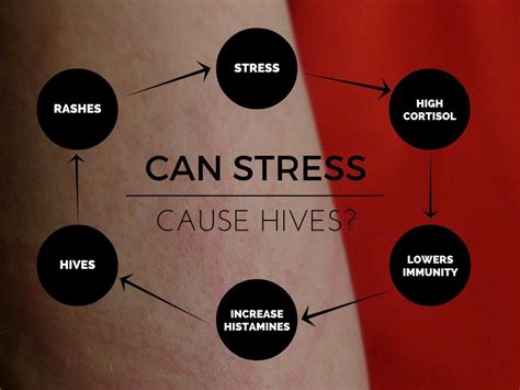Can Stress Cause Hives Dr Jannine Krause