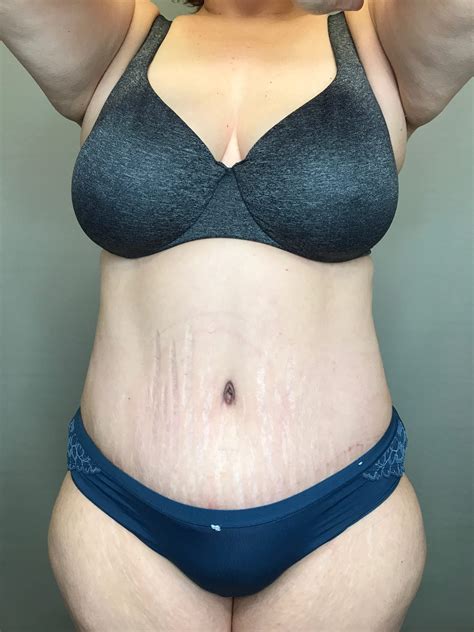 Houston Tummy Tuck Before And After Photos Plastic Surgery Photo My
