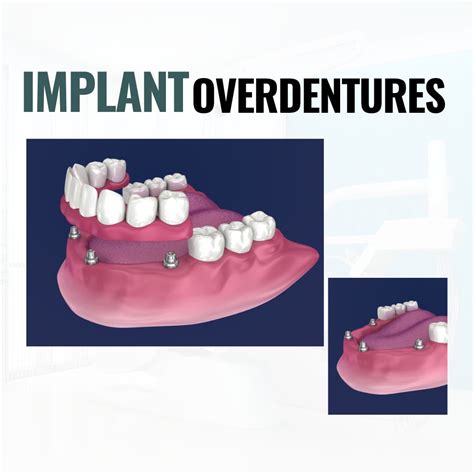 Understanding Implant Overdentures Benefits Procedure And