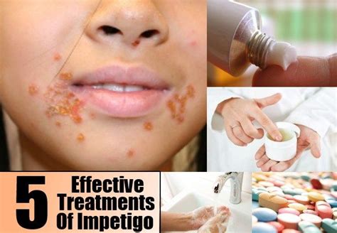 5 Effective Treatments Of Impetigo Impetigo Treatment Prevention