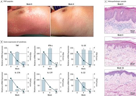 Anti Interleukin 23 As A Targeted Treatment Option For Pityriasis Rubra