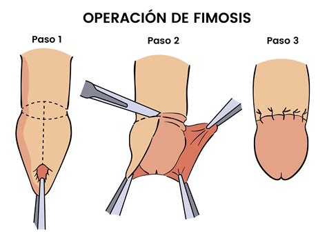 Operaci N Fimosis Duraci N Y Precio Hospital Fuensanta Madrid