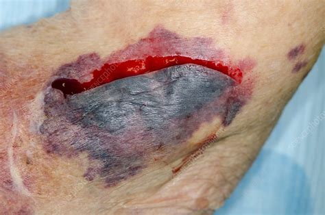 Treating a flap laceration - Stock Image - C013/0992 - Science Photo ...
