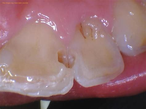 Cavity On Front Tooth Guide