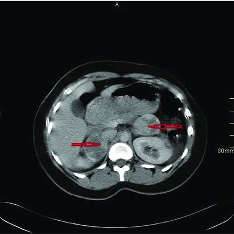 Ct Abdomen Pre Iv Contrast Showing Bilateral Adrenal Masses Download