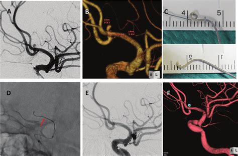 A And B Preoperative Left Internal Carotid Angiography Shows Ruptured