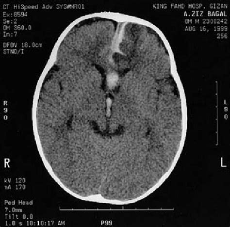 Ct Scan Of The Brain Showing Subarachnoid Hemorrhage Filling The