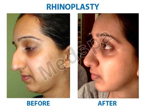 Best Rhinoplasty Surgery In Delhi Nose Surgery Cost In India