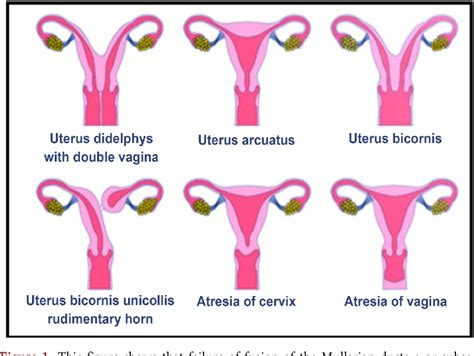 Figure 1 From Uterine Didelphys In A Pregnant Mother Semantic Scholar