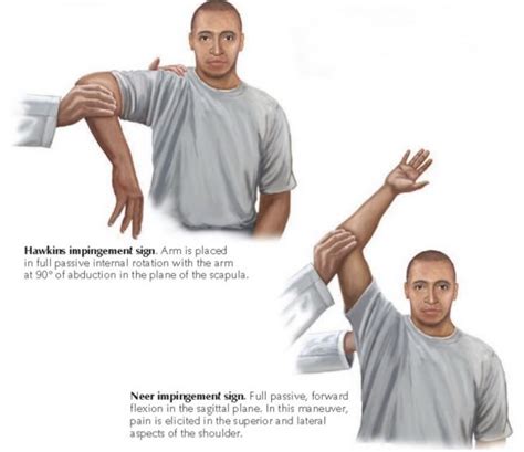 What Are Rotator Cuff Tear Symptoms Orthopaedic Specialists Pllc