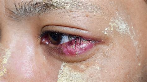 Tumor Kelopak Mata Penyebab Ciri Dan Biaya Pengobatannya