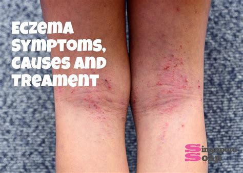 Eczema Signs And Symptoms Treatment