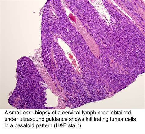 Pathology Outlines Hpv Related Oropharyngeal Squamous Cell Carcinoma