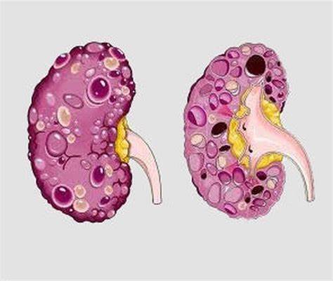 Классификация кист почек: по МКБ 10 и Босняку, парапельвикальные Картинка - Классификация кист почек: по МКБ 10 и Босняку, парапельвикальные