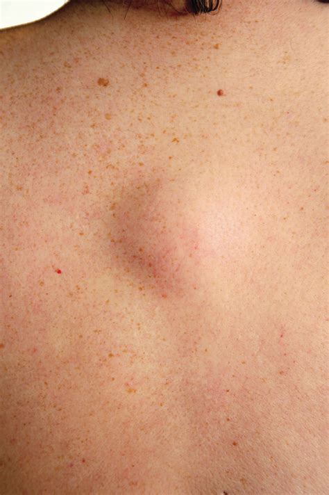 Located near the garden state plaza mall in paramus, our dermatology office has been a premier location for med spa services and cosmetic procedures for 15 years. Lipoma Causes and Treatment | U.S. Dermatology Partners